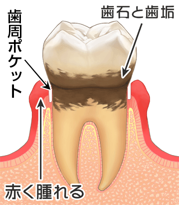 歯周病